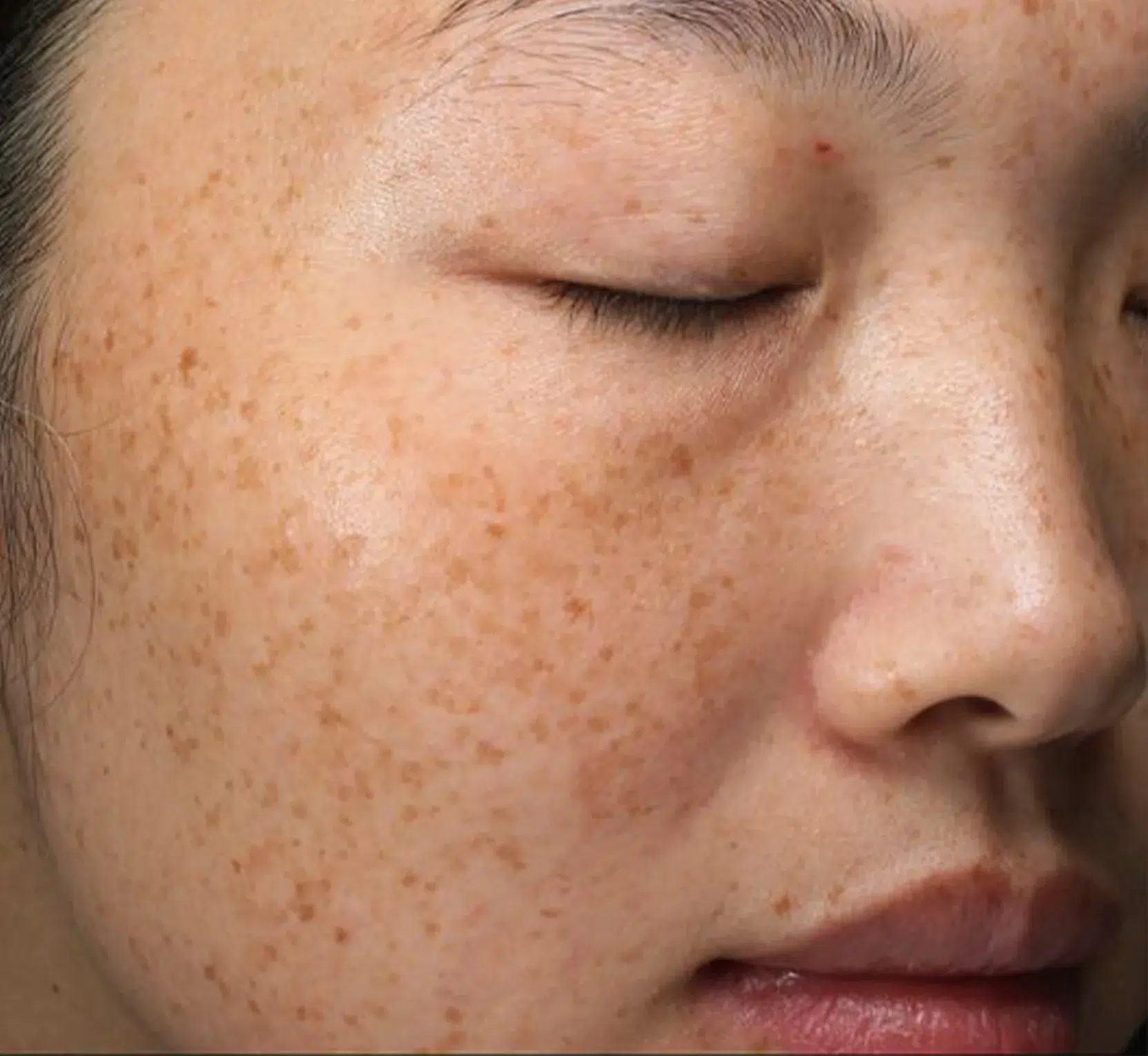 Pigmentation pre-treatment · Case 33 · Luowei Medical Aesthetics Clinic
