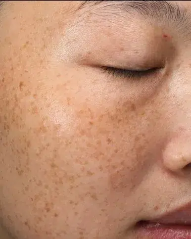 Pigmentation Before · Case 34 · Luowei Medical Aesthetics Clinic