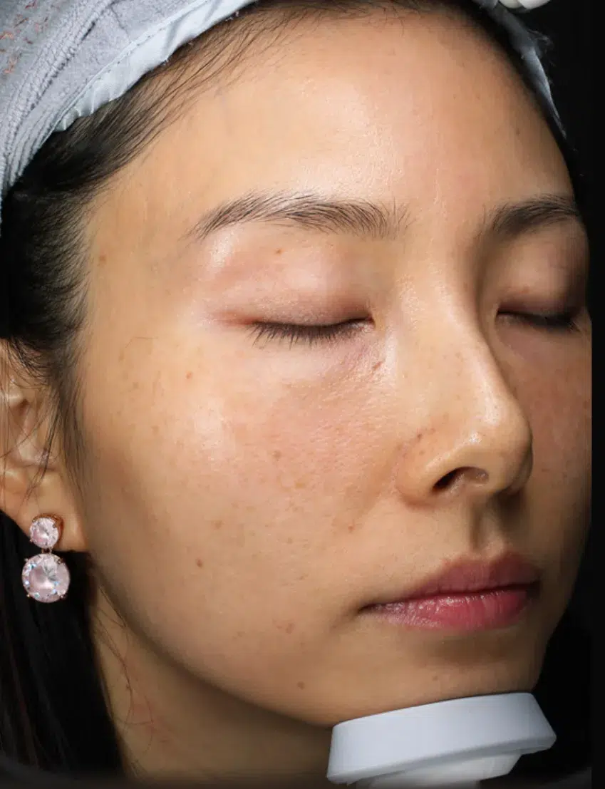 Sun Damage / Photoaging Before · Case 40 · Luowei Medical Aesthetics Clinic