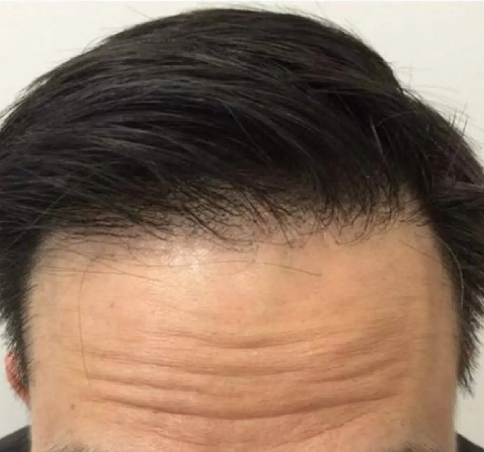 Hair Loss — After Treatment · Case 01 · Luowei Medical Aesthetics Clinic
