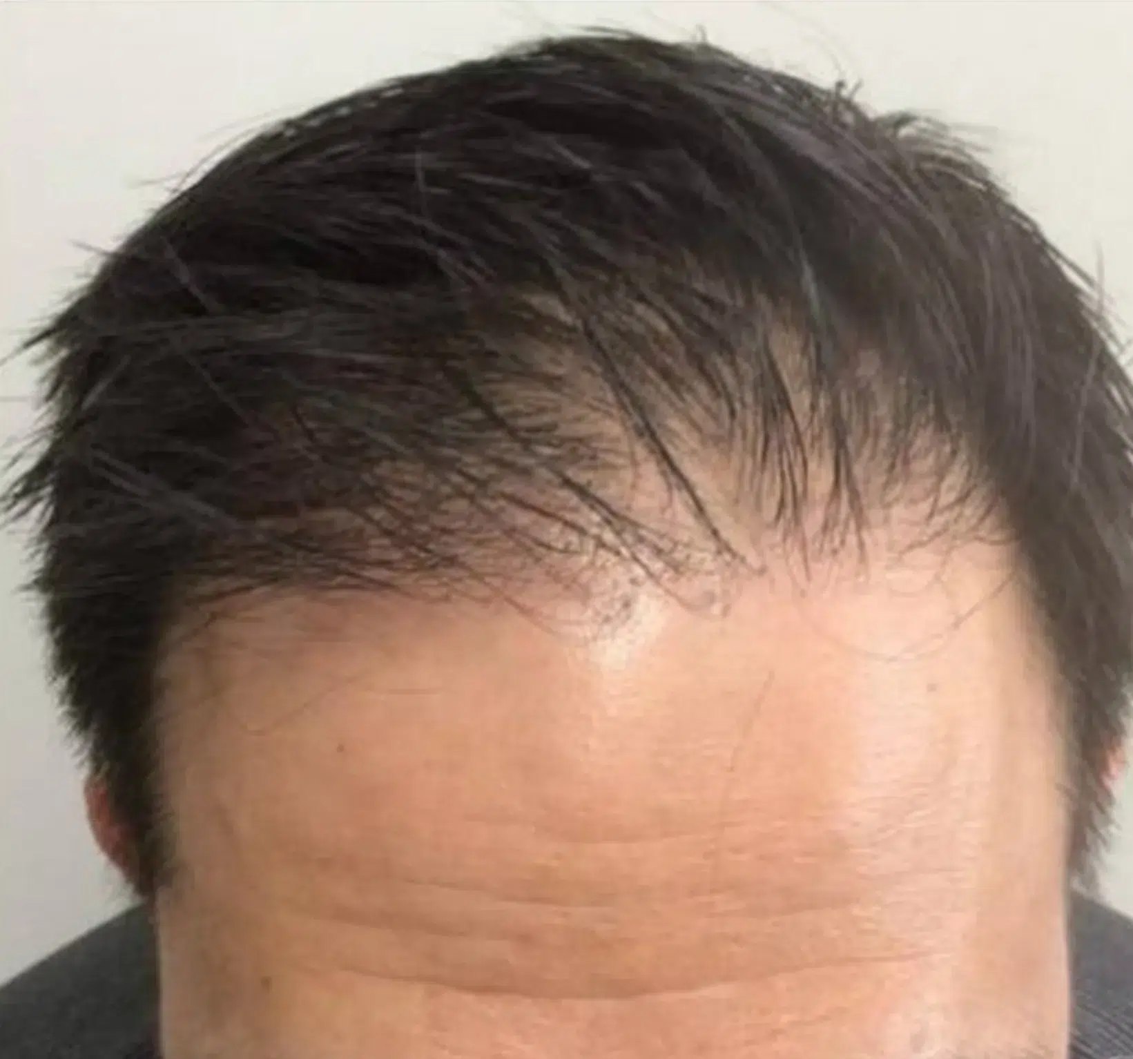 Hair Loss — Before Treatment · Case 01 · Luowei Medical Aesthetics Clinic