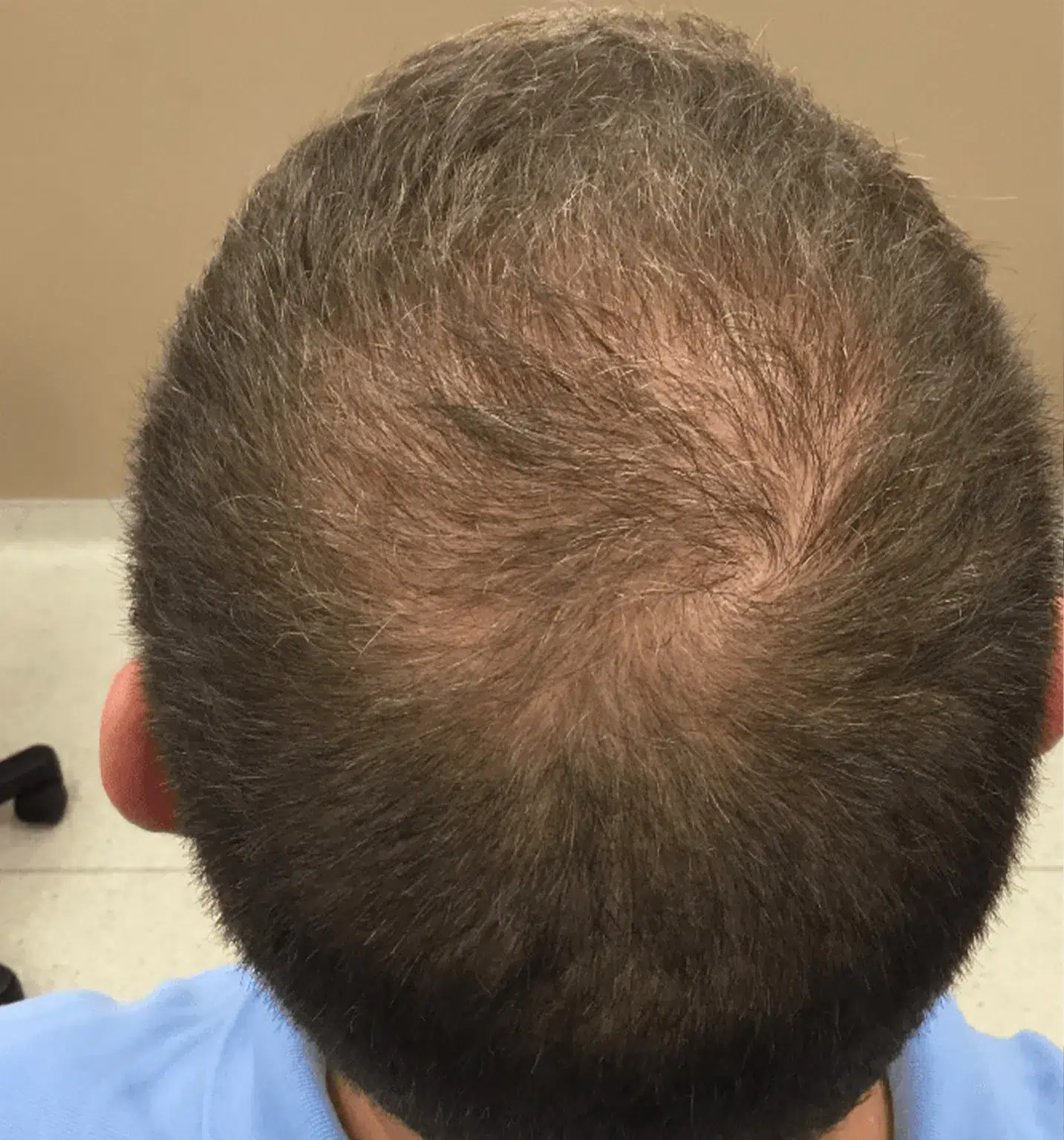 hair-thinning After Treatment · Case 2 · Luowei Medical Aesthetics Clinic