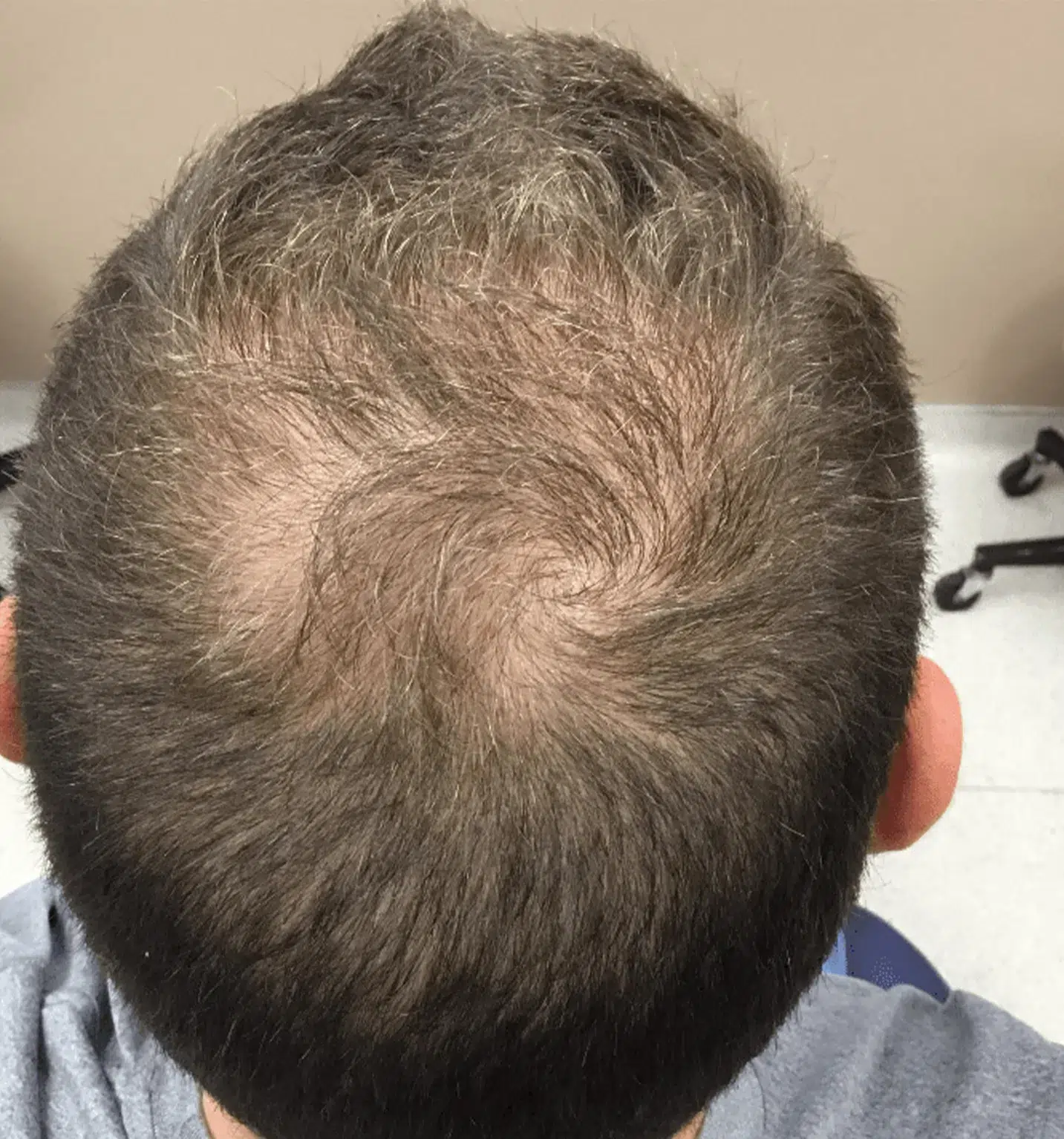 hair-thinning Before Treatment · Case 2 · Luowei Medical Aesthetics Clinic