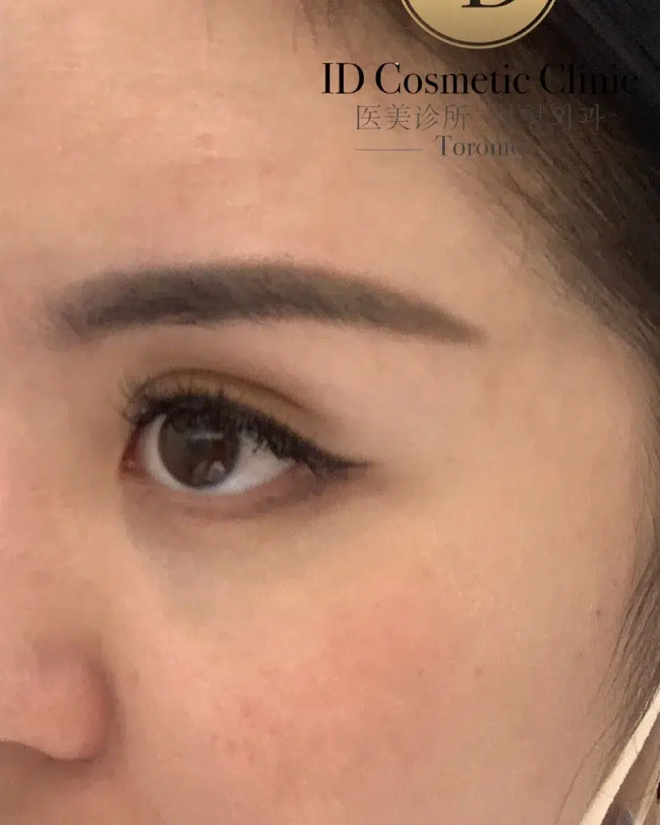 Hori's Nevus Treatment After · Case 1 · Luowei Medical Aesthetics Clinic