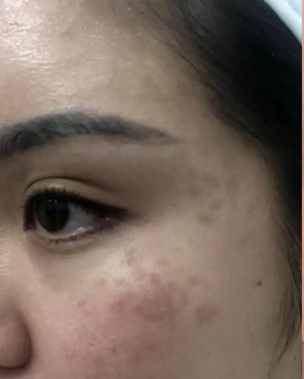 Treating Acquired Bilateral Nevus of Ota-like Macules (ABNOMs) — Before · Case 1 · Luowei Medical Aesthetics Clinic