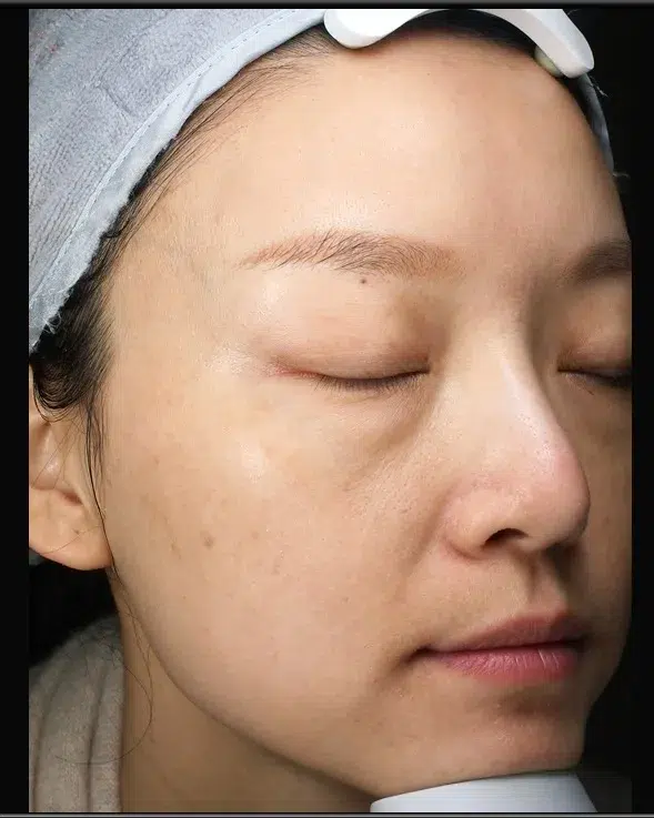 Sun Damage / Photoaging After-Treatment · Case 09 · Luowei Medical Aesthetics Clinic