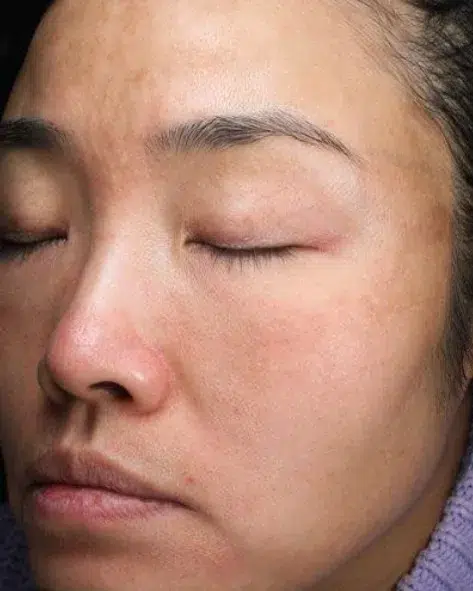 Hyperpigmentation After · Case 10 · Luowei Medical Aesthetics Clinic