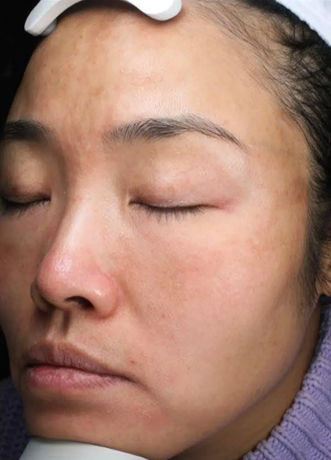Pigmentation post-treatment · Case 11 · Luowei Medical Aesthetics Clinic