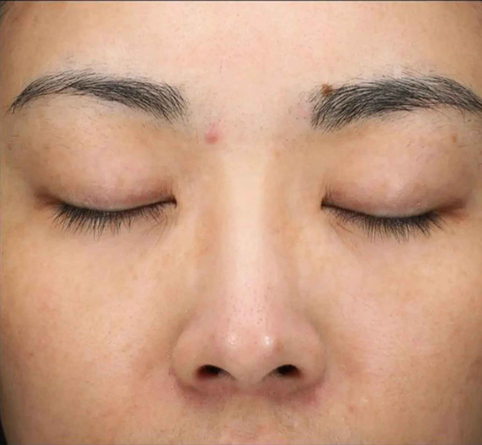 Pigmentation After · Case 12 · Luowei Medical Aesthetics Clinic