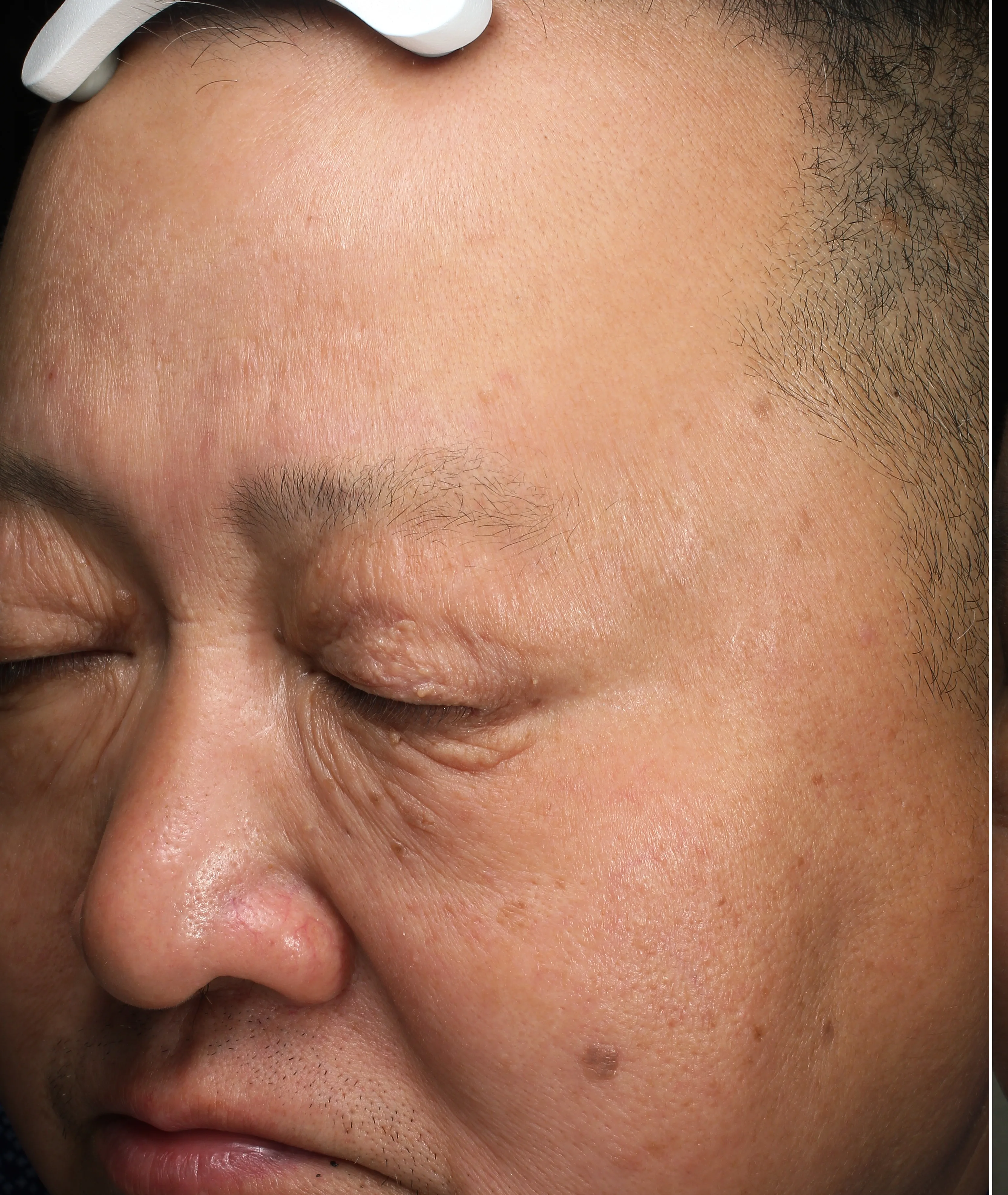 Pigmentation pre-treatment · Case 08 · Luowei Medical Aesthetics Clinic