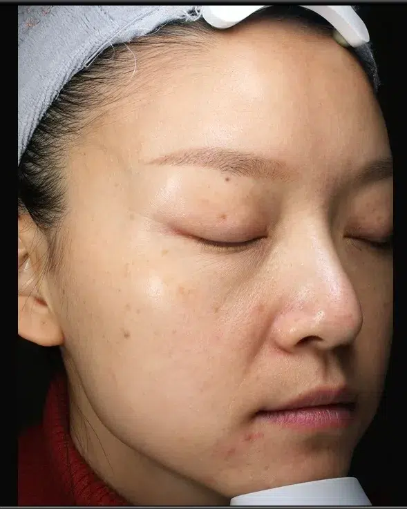 Sun Damage / Photoaging Before-Treatment · Case 09 · Luowei Medical Aesthetics Clinic