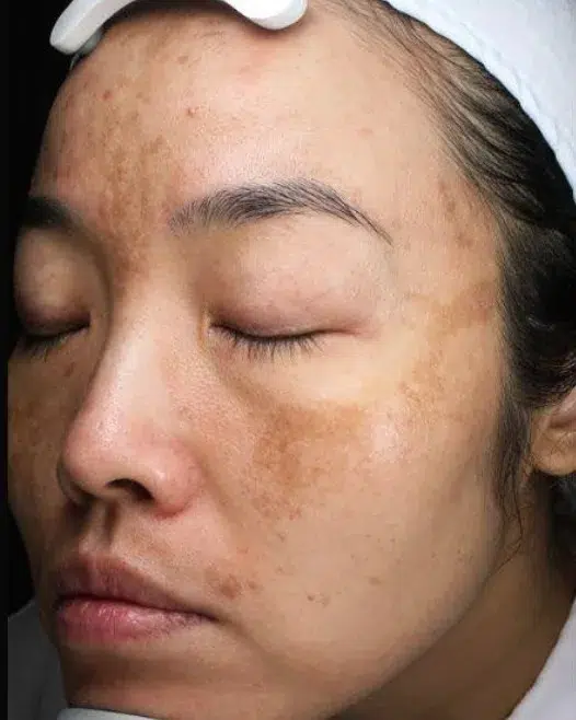 Hyperpigmentation Before · Case 10 · Luowei Medical Aesthetics Clinic