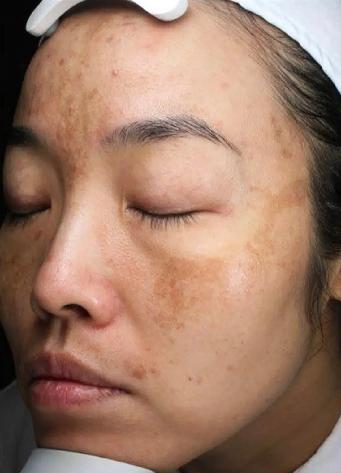 Hyperpigmentation Before · Case 11 · Luowei Medical Aesthetics Clinic