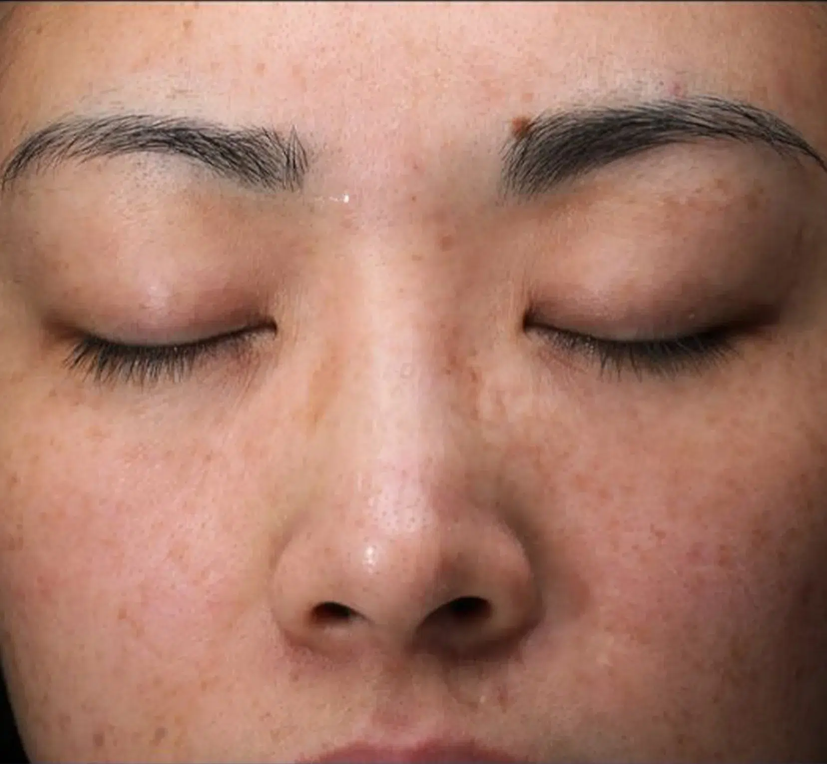 Pigmentation pre-treatment · Case 12 · Luowei Medical Aesthetics Clinic