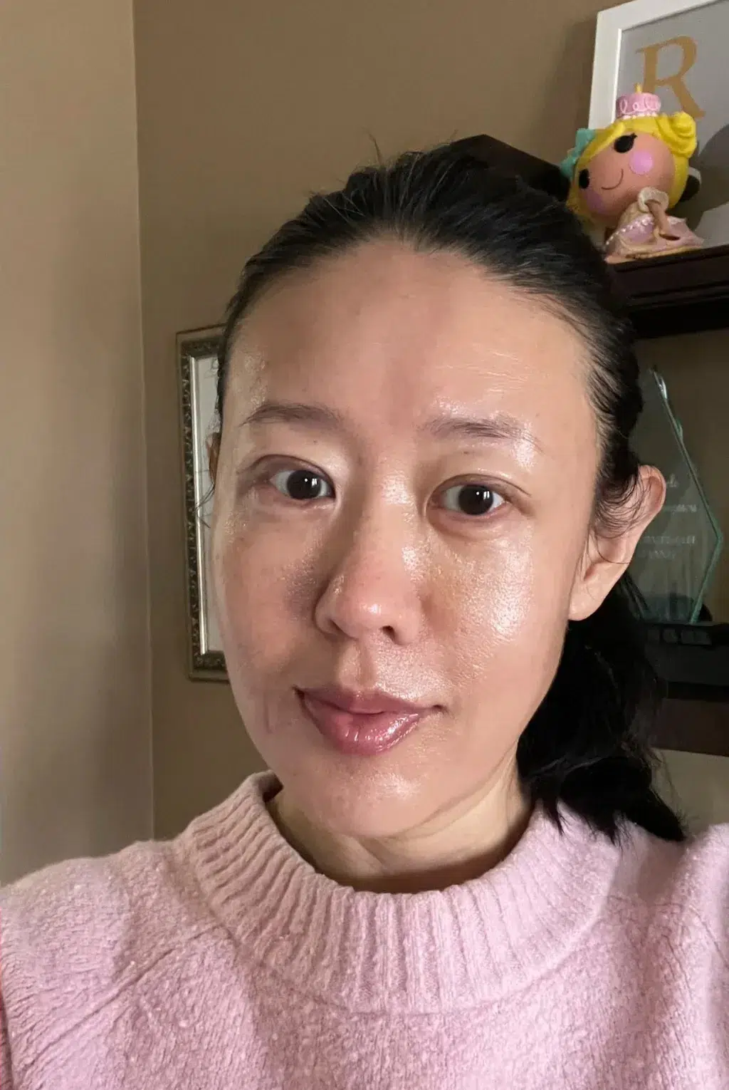 Lip Augmentation — After · Case 02 · Luowei Medical Aesthetics Clinic