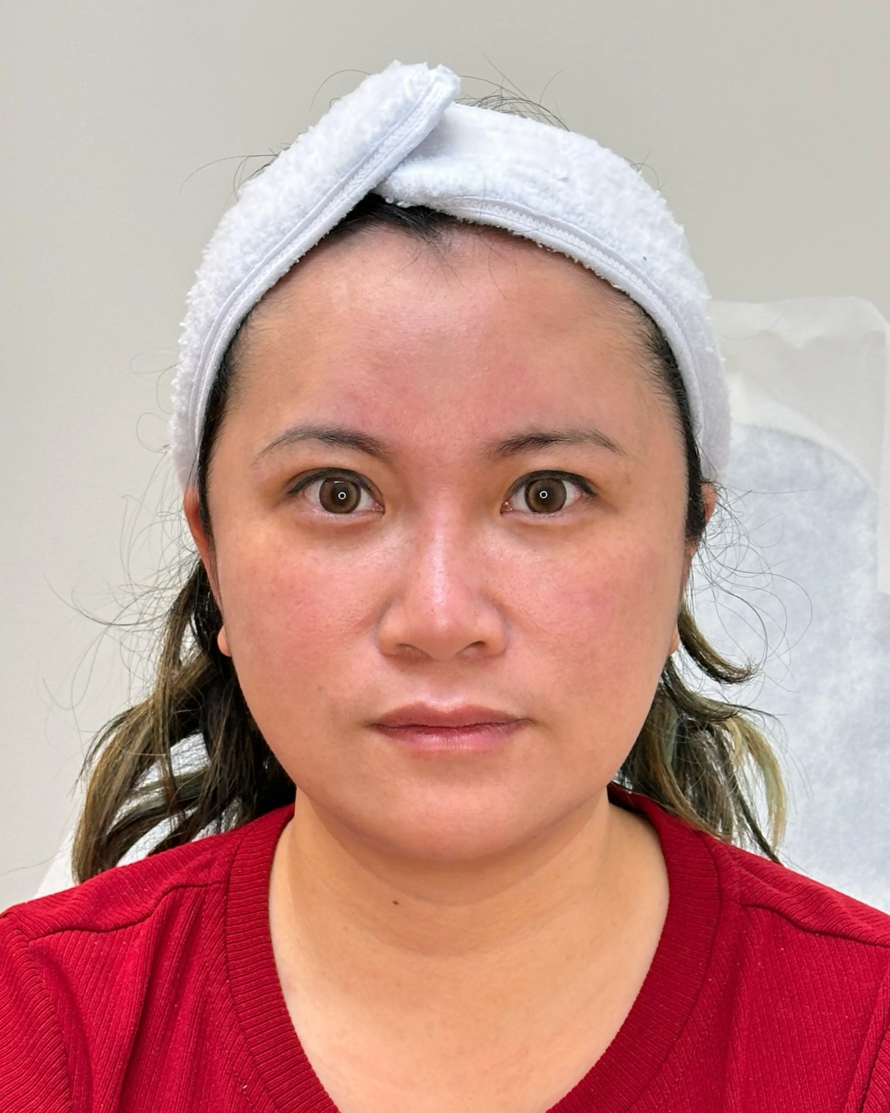 Luowei Skeletal Facial Contouring — After Treatment · Case 1 · Luowei Medical Aesthetics Clinic