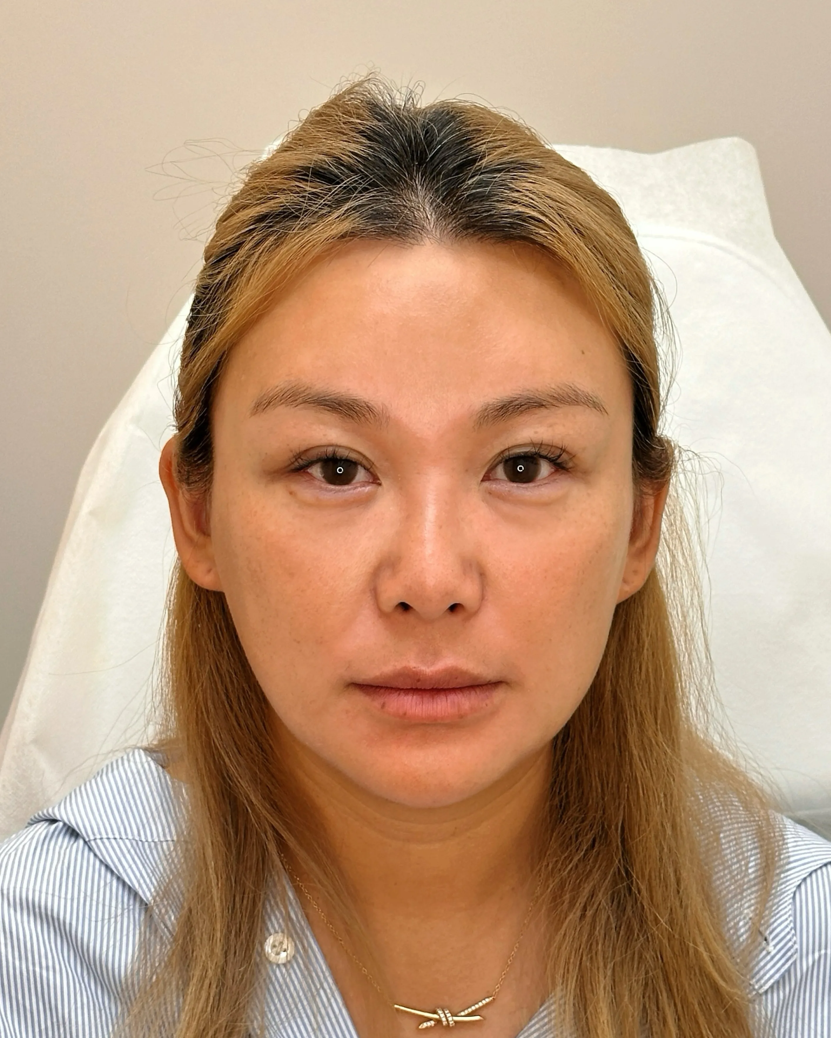 Luowei Skeletal Facial Contouring — After · Case 15 · Luowei Medical Aesthetics Clinic