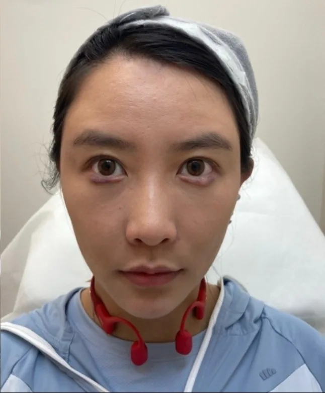 Luowei Skeletal Facial Contouring After Treatment · Case 4 · Luowei Medical Aesthetics Clinic