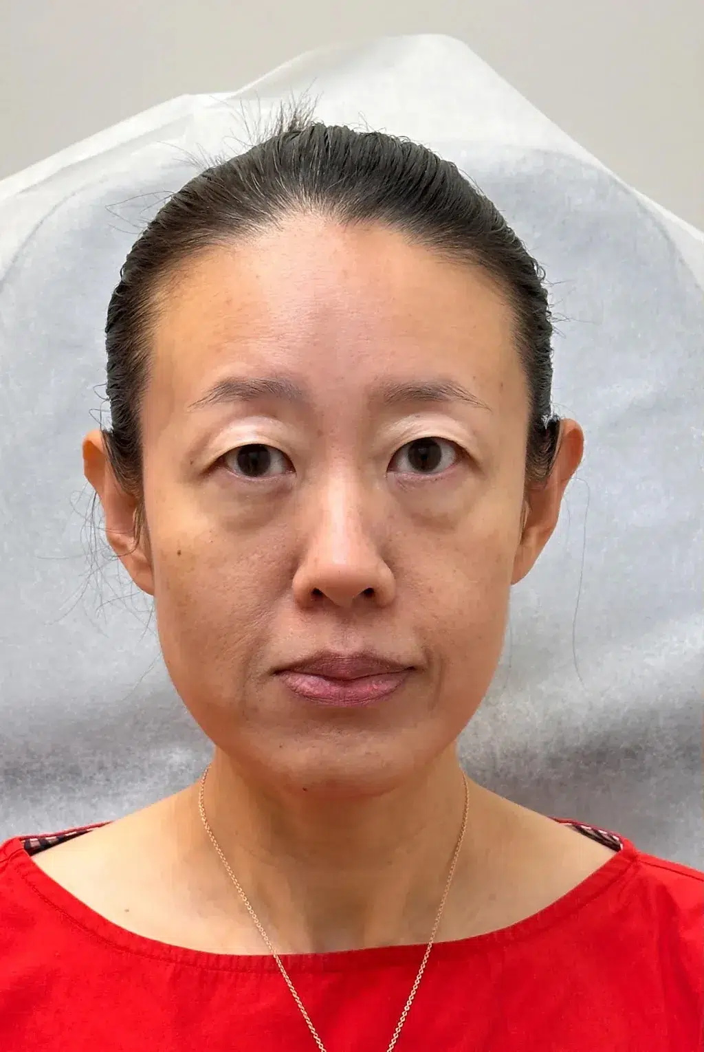 Lip Augmentation — Before · Case 02 · Luowei Medical Aesthetics Clinic