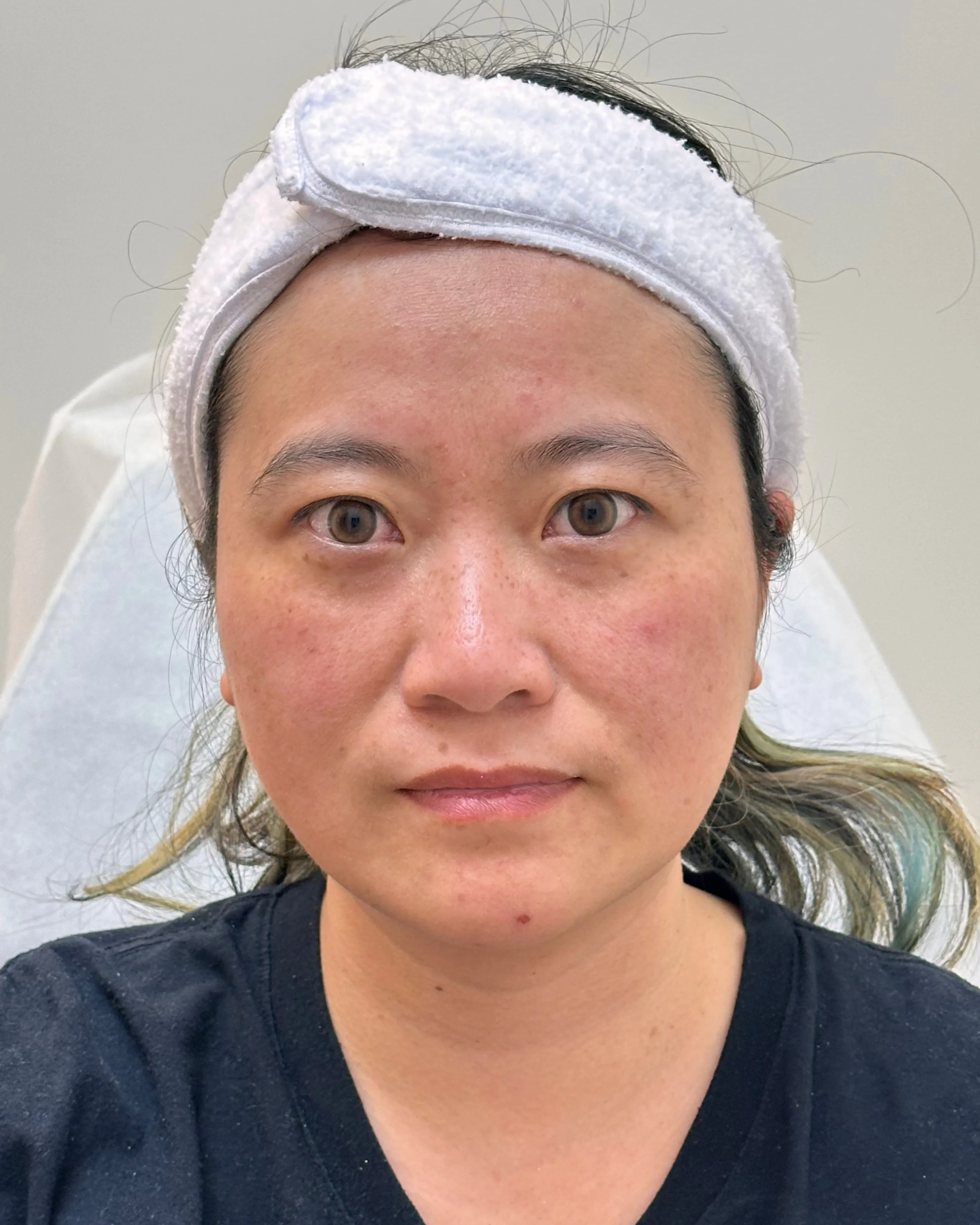Luowei Skeletal Facial Contouring — Before Treatment · Case 1 · Luowei Medical Aesthetics Clinic