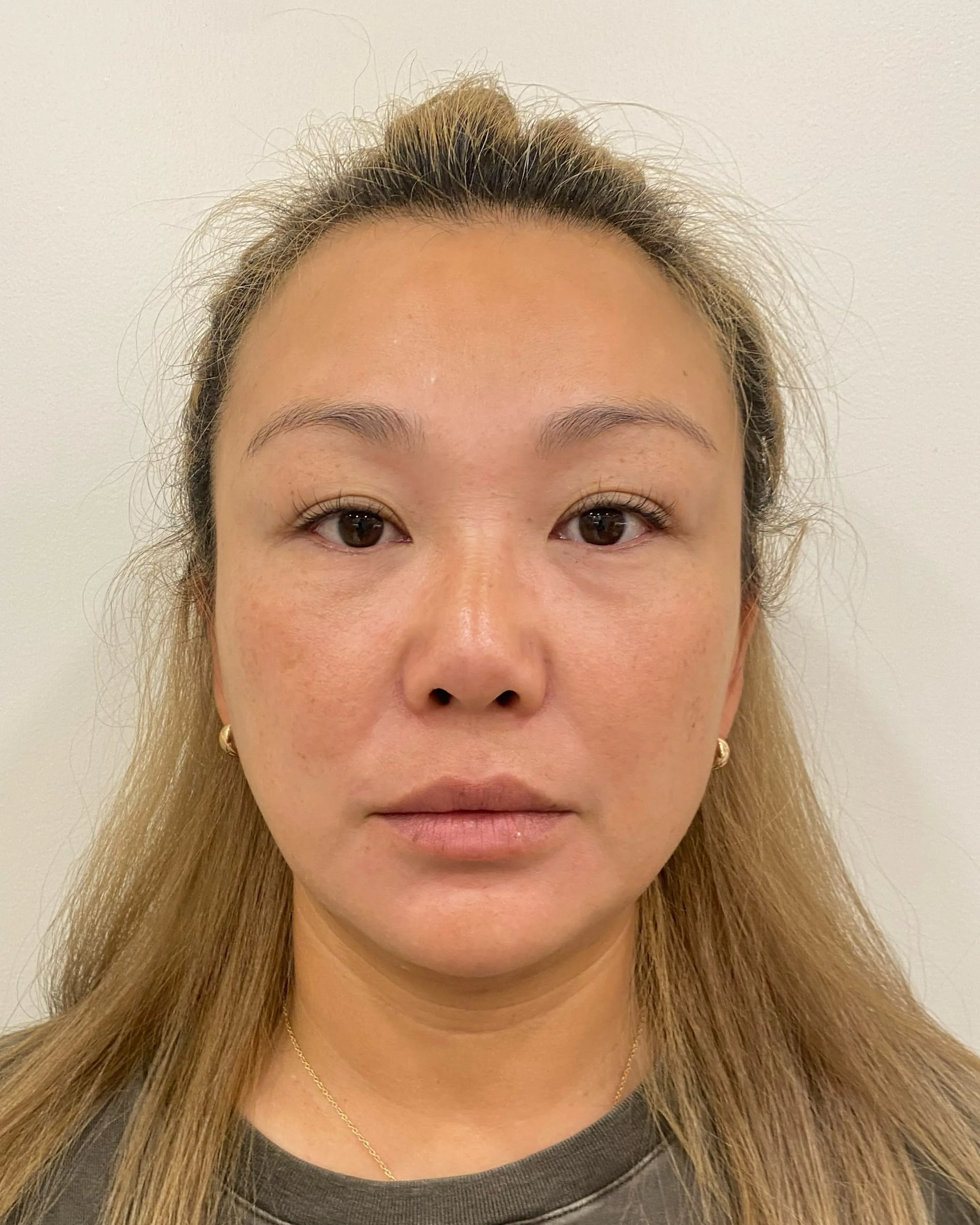 Luowei Facial Sculpturing · Before · Case 15 · Luowei Medical Aesthetics Clinic