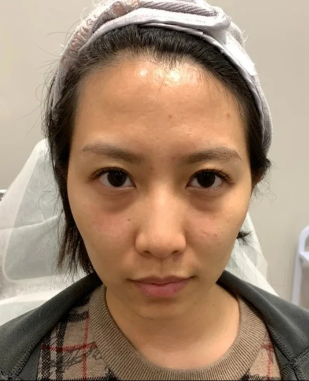 Luowei Skeletal Facial Contouring — Before · Case 4 · Luowei Medical Aesthetics Clinic