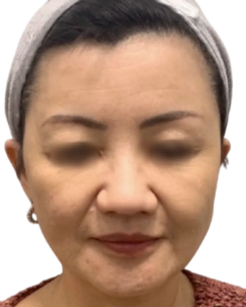 Jawline Contouring Post-Treatment · Case 2 · Luowei Medical Aesthetics Clinic