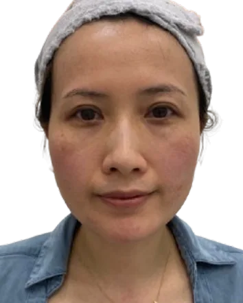 Jawline Definition — After · Case 22 · Luowei Medical Aesthetics Clinic