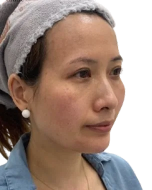 Jawline Laxity — Post-Treatment · Case 43 · Luowei Medical Aesthetics Clinic