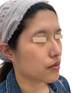 Jawline definition — After Treatment · Case 24 · Luowei Medical Aesthetics Clinic