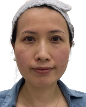 Jawline Definition — Before · Case 22 · Luowei Medical Aesthetics Clinic