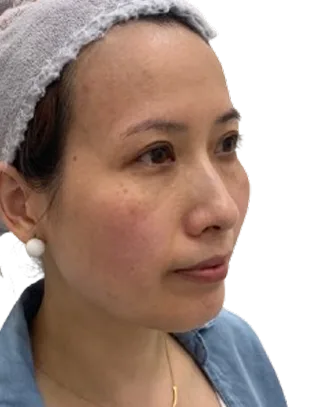 Jawline Laxity — Before Treatment · Case 43 · Luowei Medical Aesthetics Clinic