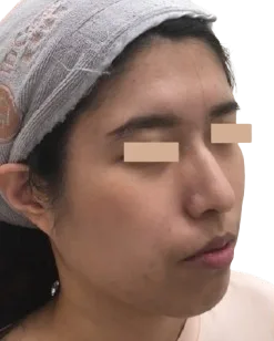 Jawline definition — Before Treatment · Case 24 · Luowei Medical Aesthetics Clinic