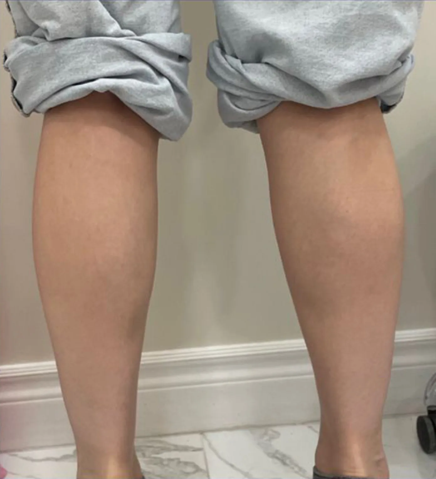 Calf Slimming — After Treatment · Case 2 · Luowei Medical Aesthetics Clinic