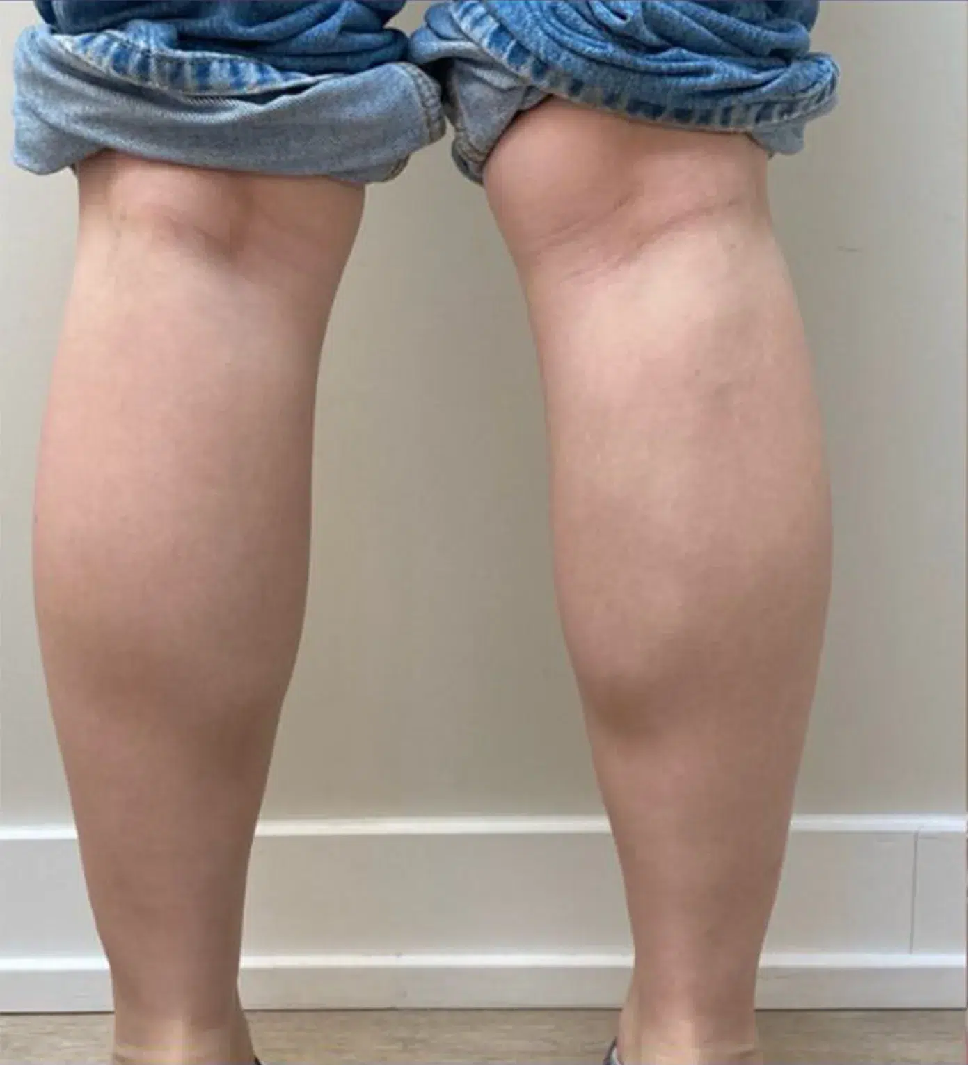 Calf Slimming — Before · Case 2 · Luowei Medical Aesthetics Clinic
