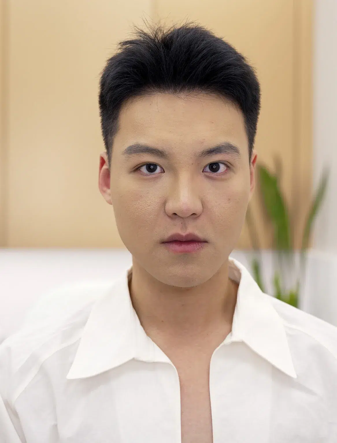 Post-Inflammatory Hyperpigmentation — After Treatment · Case 02 · Luowei Medical Aesthetics Clinic