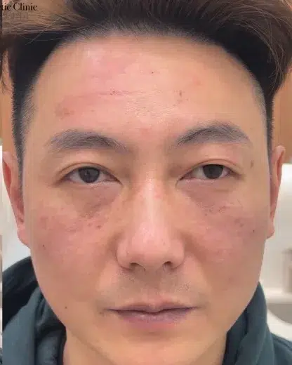 Facial Fatigue / Aged Appearance / Dull Complexion — After · Case 03 · Luowei Medical Aesthetics Clinic