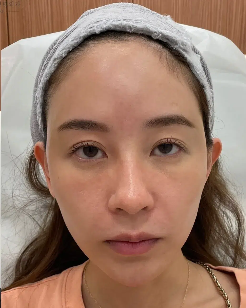 Tired, Aged & Fatigued Appearance — After Treatment · Case 08 · Luowei Medical Aesthetics Clinic