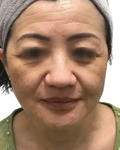 Facial Fatigue / Aged Appearance / Tired Look — Before · Case 01 · Luowei Medical Aesthetics Clinic