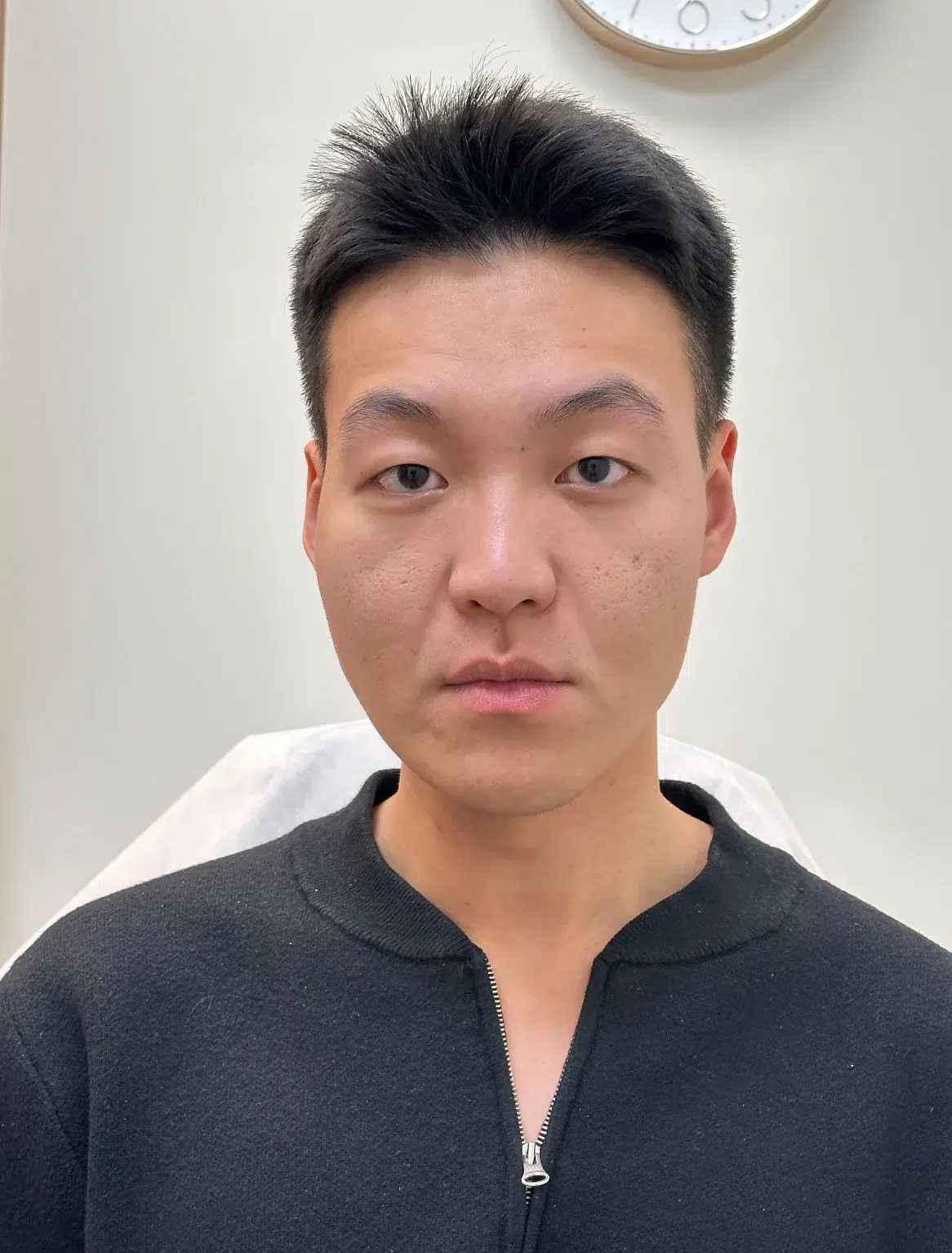 Post-Inflammatory Hyperpigmentation — Before Treatment · Case 02 · Luowei Medical Aesthetics Clinic