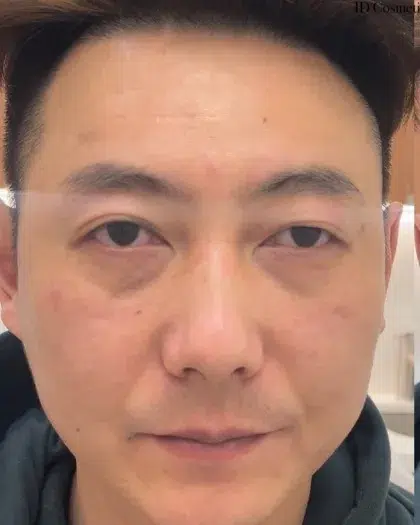 Facial Fatigue / Aged Appearance / Dull Complexion — Before · Case 03 · Luowei Medical Aesthetics Clinic