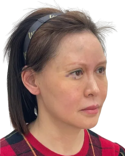 Marionette Lines — Post-Treatment · Case 01 · Luowei Medical Aesthetics Clinic