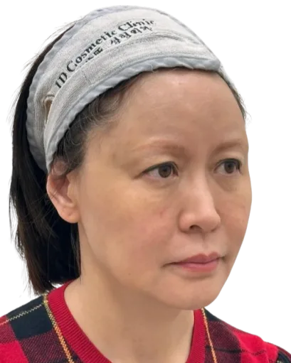 Marionette Lines — Before Treatment · Case 01 · Luowei Medical Aesthetics Clinic