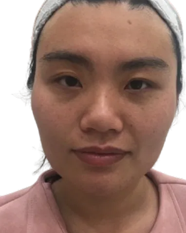 Masseter Hypertrophy — After Treatment · Case 1 · Luowei Medical Aesthetics Clinic