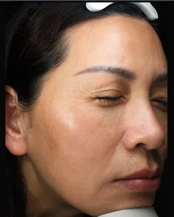Hyperpigmentation After · Case 09 · Luowei Medical Aesthetics Clinic