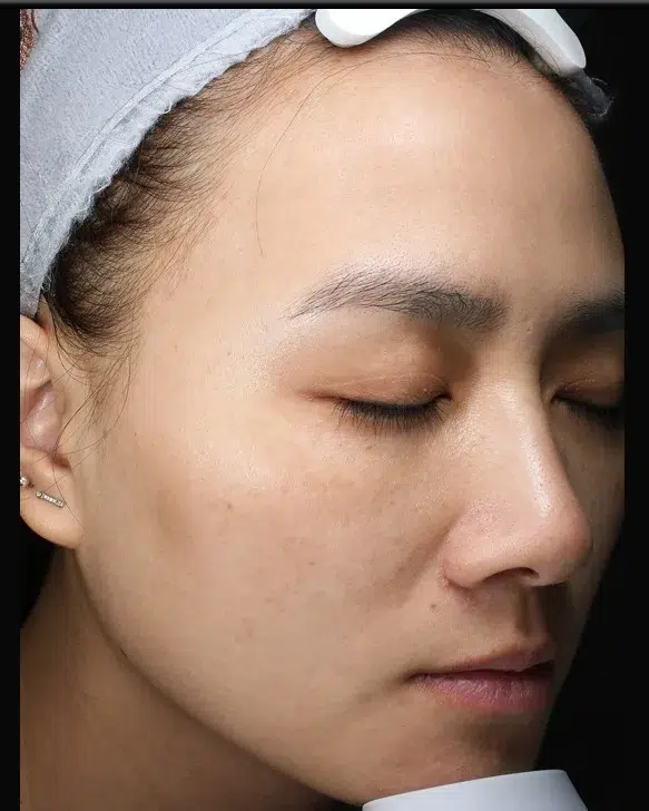 Treating Melasma — After Treatment · Case 16 · Luowei Medical Aesthetics Clinic