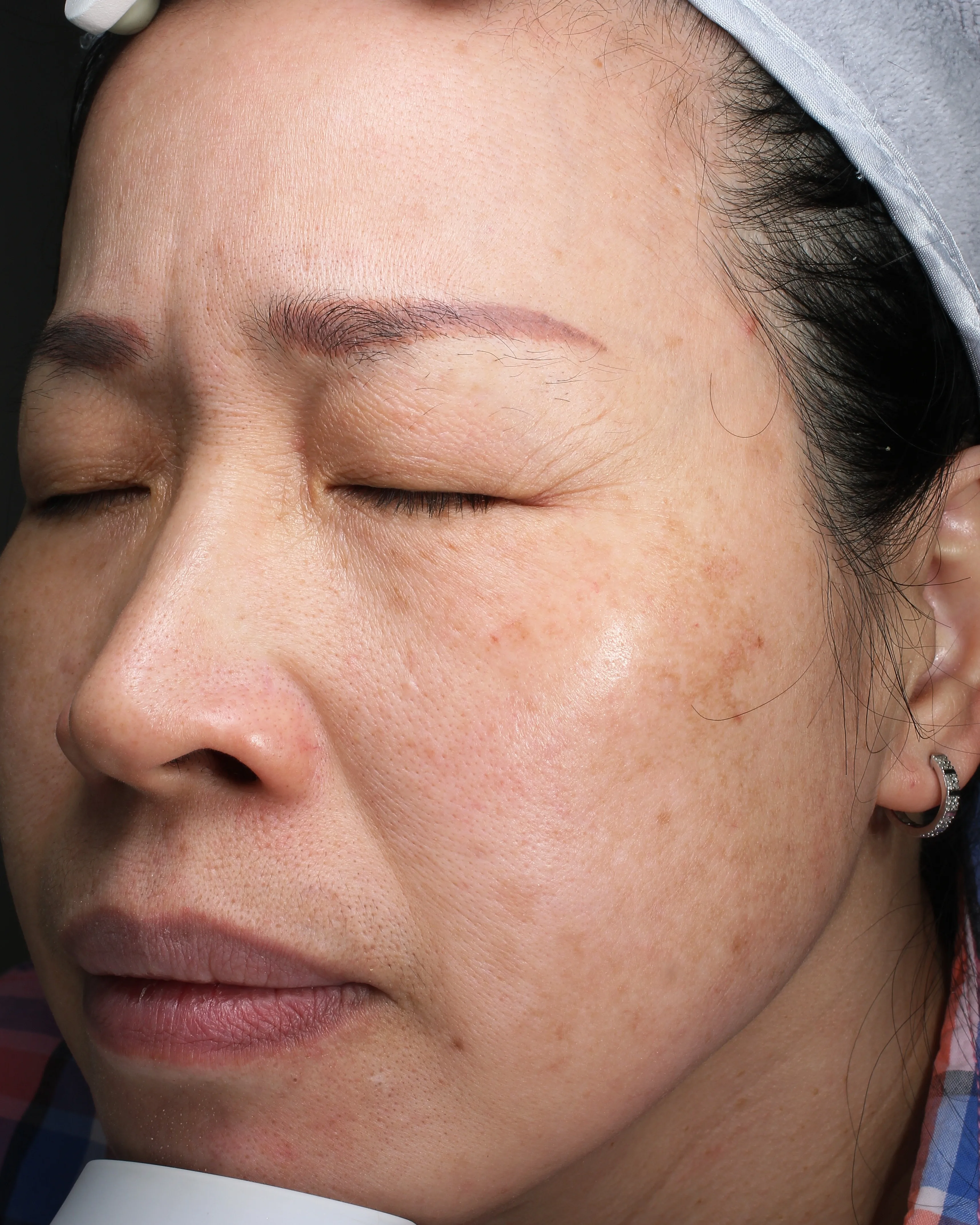 Treating melasma — After · Case 18 · Luowei Medical Aesthetics Clinic