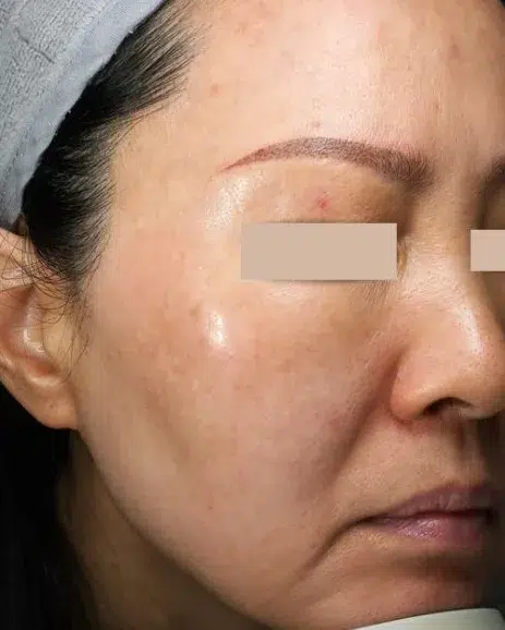 Pigmentation post-treatment · Case 18 · Luowei Medical Aesthetics Clinic