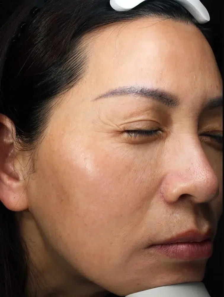 Pigmentation After · Case 20 · Luowei Medical Aesthetics Clinic