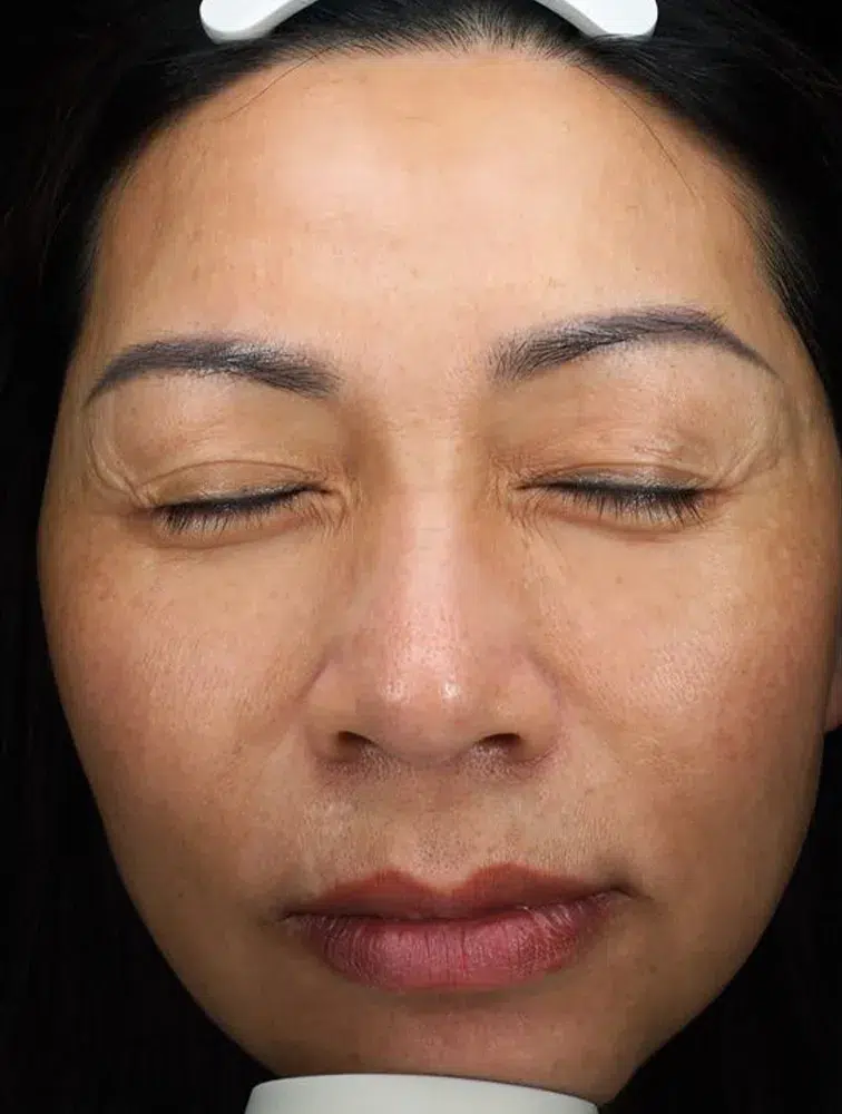 Melasma — After · Case 41 · Luowei Medical Aesthetics Clinic